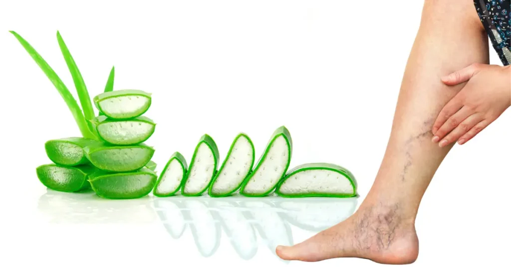aloe vera para várices
