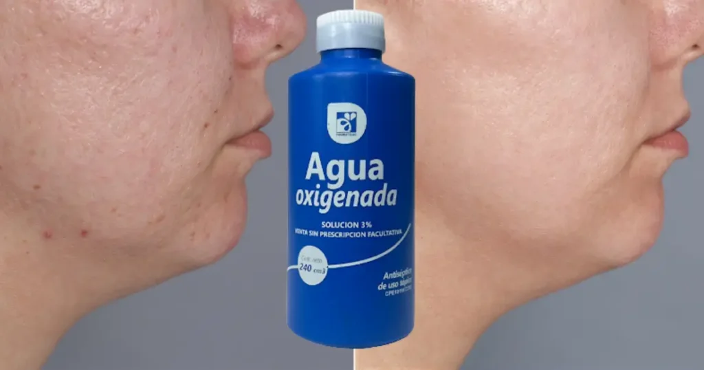 agua oxigenada para manchas y arrugas